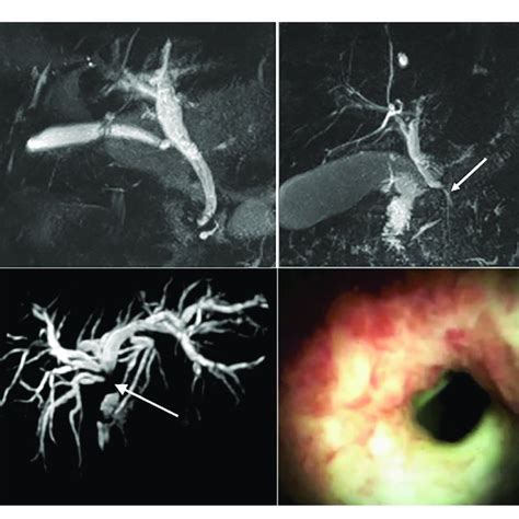 | Top left: Magnetic resonance imaging (MRI) of a normal biliary tree.... | Download Scientific ...