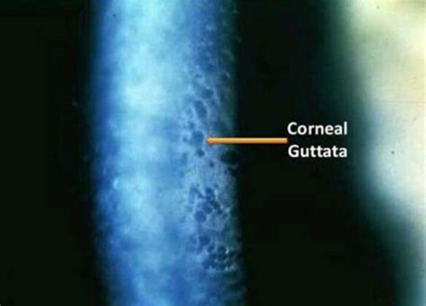 Cornea Guttata: Symptoms And Treatment | How Relate To Phaco