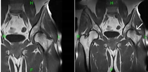 Femoro-Acetabular Impingement-MRI - Sumer's Radiology Blog