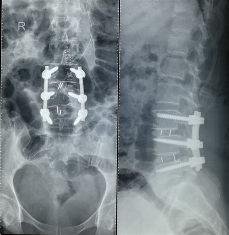 Lumbar Spinal Fusion Problems | Hot Sex Picture