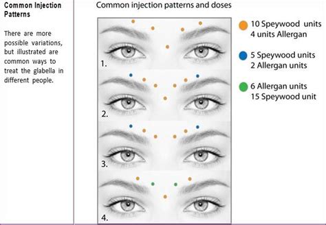 glabella botox - Google Search | Botox injection sites, Botox, Botox face