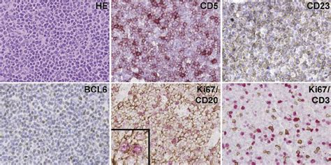 Histology of lymph node infiltrated by B-CLL cells. Ubiquitously... | Download Scientific Diagram