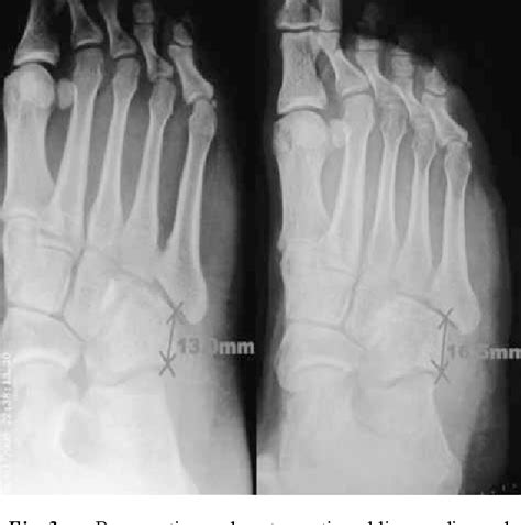 [PDF] Nutcracker fracture of the cuboid: management and results ...