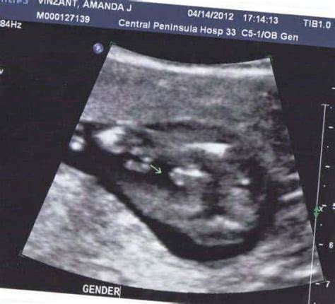 Boy or Girl Ultrasound Wrong? Gender Scan Accuracy