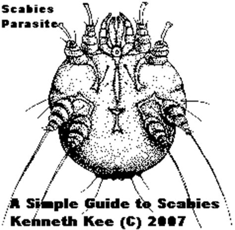 A Simple Guide to Scabies | A Family Doctor's Tale