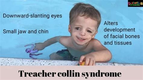 Treacher collins syndrome | Symptoms Treacher collins syndrome