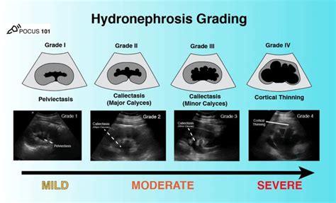 Renal Ultrasound Made Easy: Step-By-Step Guide | Ultrasound, Ultrasound sonography, Medical ...