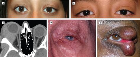 Angiolymphoid Hyperplasia With Eosinophilia of the Orbit and Ocular Adnexa: Report of 5 Cases ...