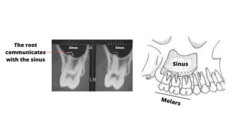 How can a failed root canal cause a sinus infection (X-ray examples)?