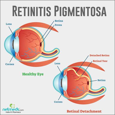 Cure For Rp Eye Disease - Captions Ideas