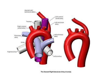 Aberrant right subclavian artery anomaly 3D model 3D printable | CGTrader