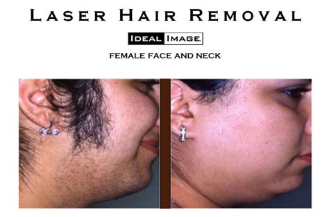 I Want The Laser Hair Removal From Ideal Image - Verastic