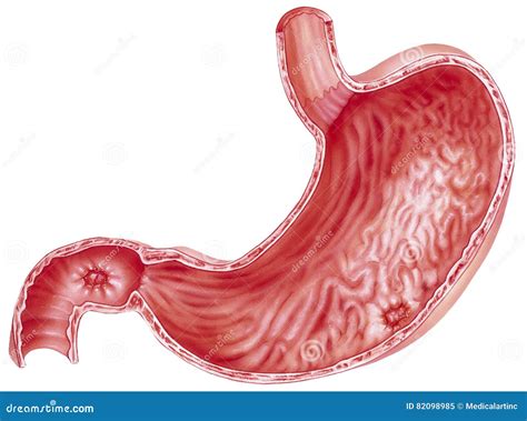 Stomach - Peptic Ulcers Stock Image | CartoonDealer.com #82098985