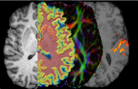 Structural and functional brain MRI: overview of image analysis methods ...