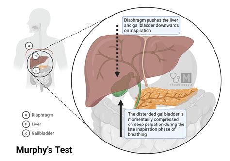 Physical Exam : Murphy’s Sign - My Endo Consult