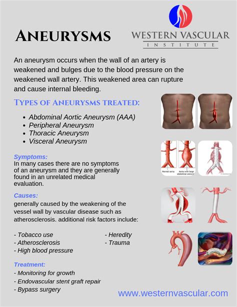 Aneurysms - Western Vascular Institute