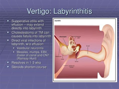 Labyrinthitis Causes Symptoms Diagnosis And Treatment - vrogue.co