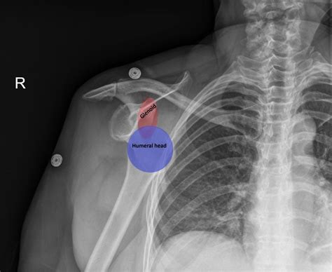 Anterior Shoulder Dislocation