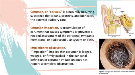 Impacted Cerumen