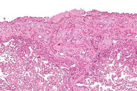 Epithelioid Mesothelioma - LLB TULIP