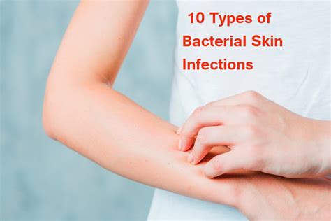 10 Types of Bacterial Skin Infections - Yabibo