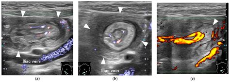 A Pediatric Case of Inverted Meckel’s Diverticulum Presenting with ...