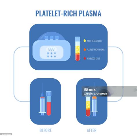 Plasma Darah Manusia Setelah Poster Infografis Sentrifugasi Ilustrasi Stok - Unduh Gambar ...