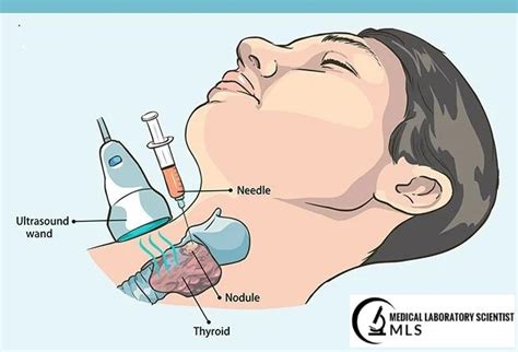 FINE NEEDLE ASPIRATION (FNA) BIOPSY: Purpose, Procedure, Uses, Complications and Advantages ...