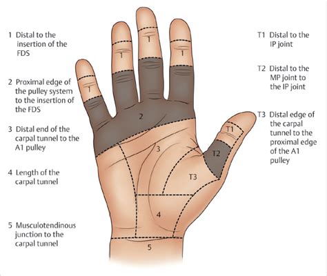 4 Flexor Tendon Repair (Zone 2) | Plastic Surgery Key