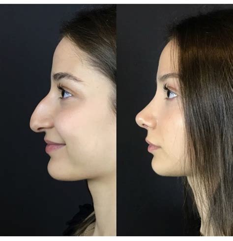 nose job recovery process - Belkis Dow