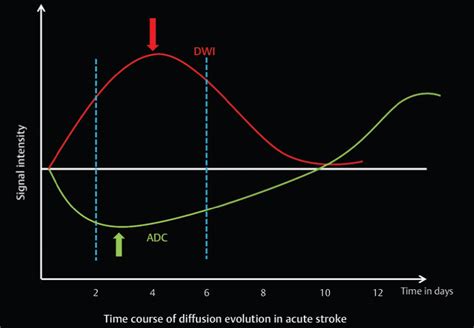 Reliability of Diffusion Weighted Imaging in Imaging of Stroke