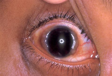 Vernal keratoconjunctivitis. | Allergic conjunctivitis showi… | Flickr