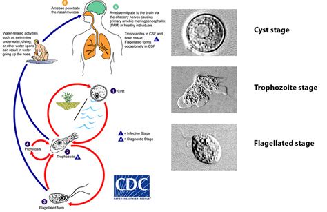 Primary amebic meningoencephalitis causes, symptoms, diagnosis & treatment