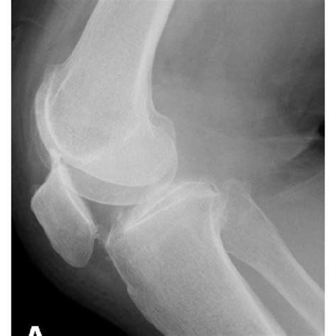 The moving patellar apprehension test examination technique. A, The... | Download Scientific Diagram