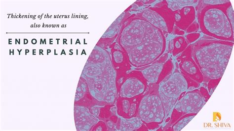 Endometrial Hyperplasia | Causes, Symptoms and Treatment