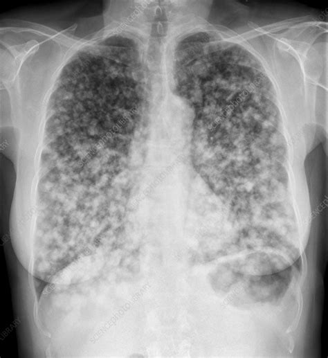 lung cancer pictures x ray - کامل (مولیزی)