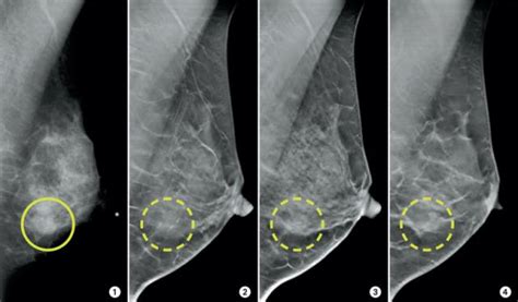 3-D mammograms may improve accuracy of breast cancer screening | Centre for Imaging Technology ...