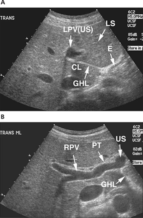 Lesser Sac Ultrasound