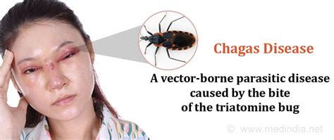 Chagas Disease - Causes, Symptoms, Diagnosis, Treatment & Prevention