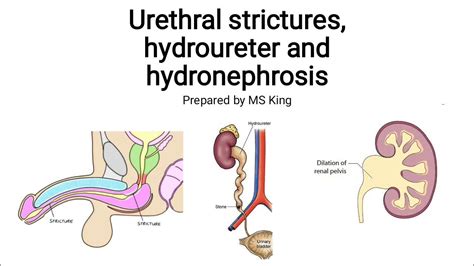 Urethral strictures / hydroureter and hydronephrosis - YouTube