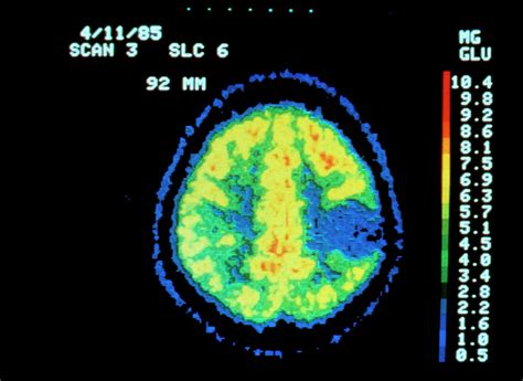 Coloured Pet Scan Of The Brain Showing A Tumour Photograph by National Cancer Institute/science ...