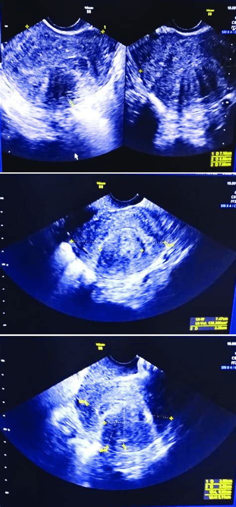 Transvaginal ultrasound shows submucosal uterine fibroid with size 3.4... | Download Scientific ...