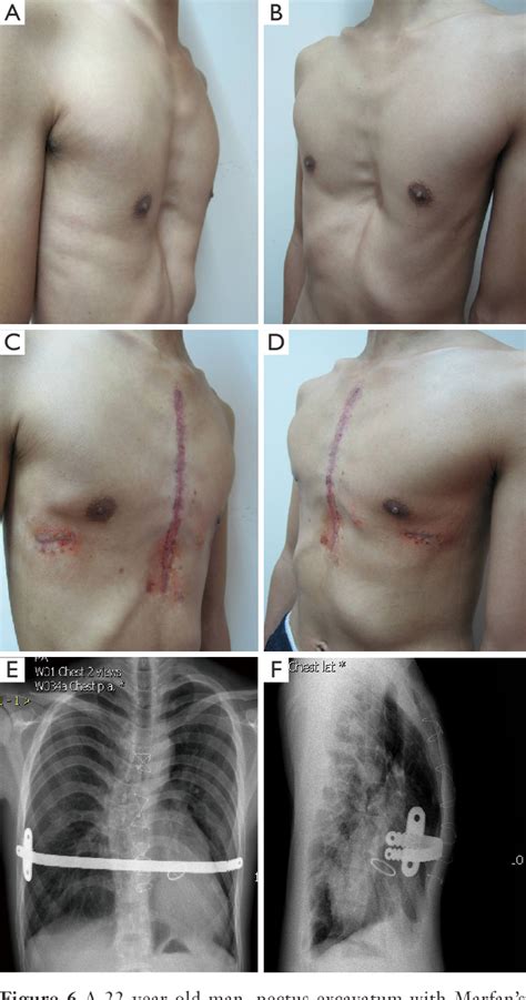 Pectus Excavatum Bar