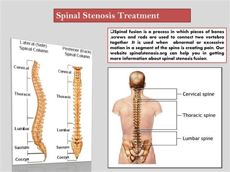 PPT - Lumbar Spinal Stenosis Surgery PowerPoint Presentation, free ...