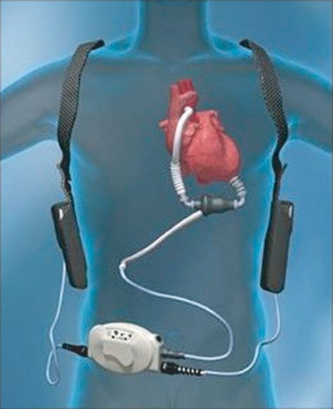 Exercise Therapy for an Older Patient With Left Ventricular Assist Device (PDF Download Available)