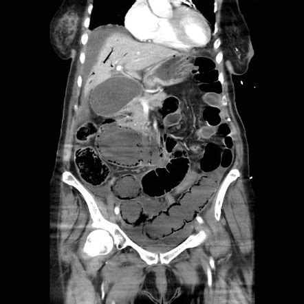 Ischemic bowel | Radiology Case | Radiopaedia.org