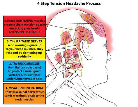 Trigger Point Therapy - Tension Type Headaches (TTH) – Niel Asher Healthcare