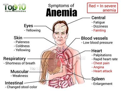 Home Remedies for Anemia | Top 10 Home Remedies