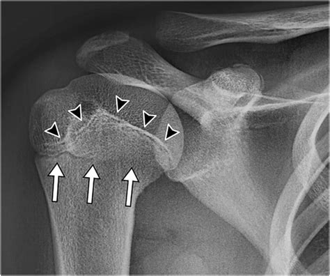 Normal Humerus X Ray Growth Plates