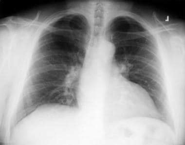 Chest X Ray Pulmonary Embolism